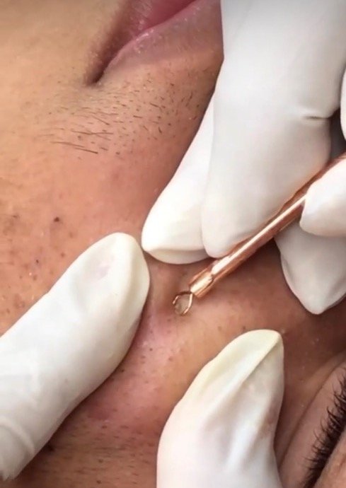 Limpieza facial